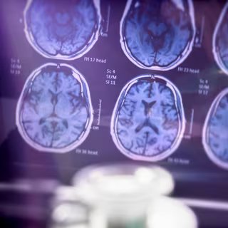Dans la maladie d’Alzheimer, certaines lésions sont localisées à l’intérieur des neurones sous forme d’enchevêtrements fibrillaires, d’autres forment des plaques au niveau du tissu cérébral. © digicomphoto, iStock