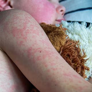 La maladie a entraîné des hospitalisations pour près d'un tiers des cas (144), surtout des enfants de moins de cinq ans et des adultes de plus de 30 ans. © Povorozniuk Liudmyla, Getty Images