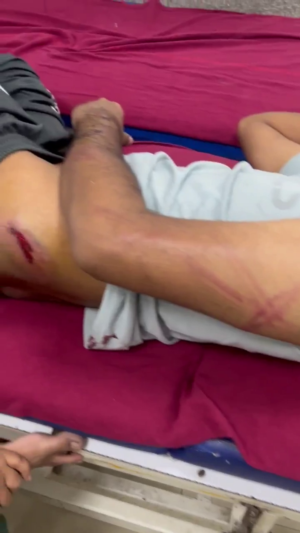 Cette vidéo, diffusée par un compte proche du "Parti des cafards", montre les blessures et les ecchymoses impressionnantes laissées par les coups de "lathis" des policiers sur le corps d'un manifestant.